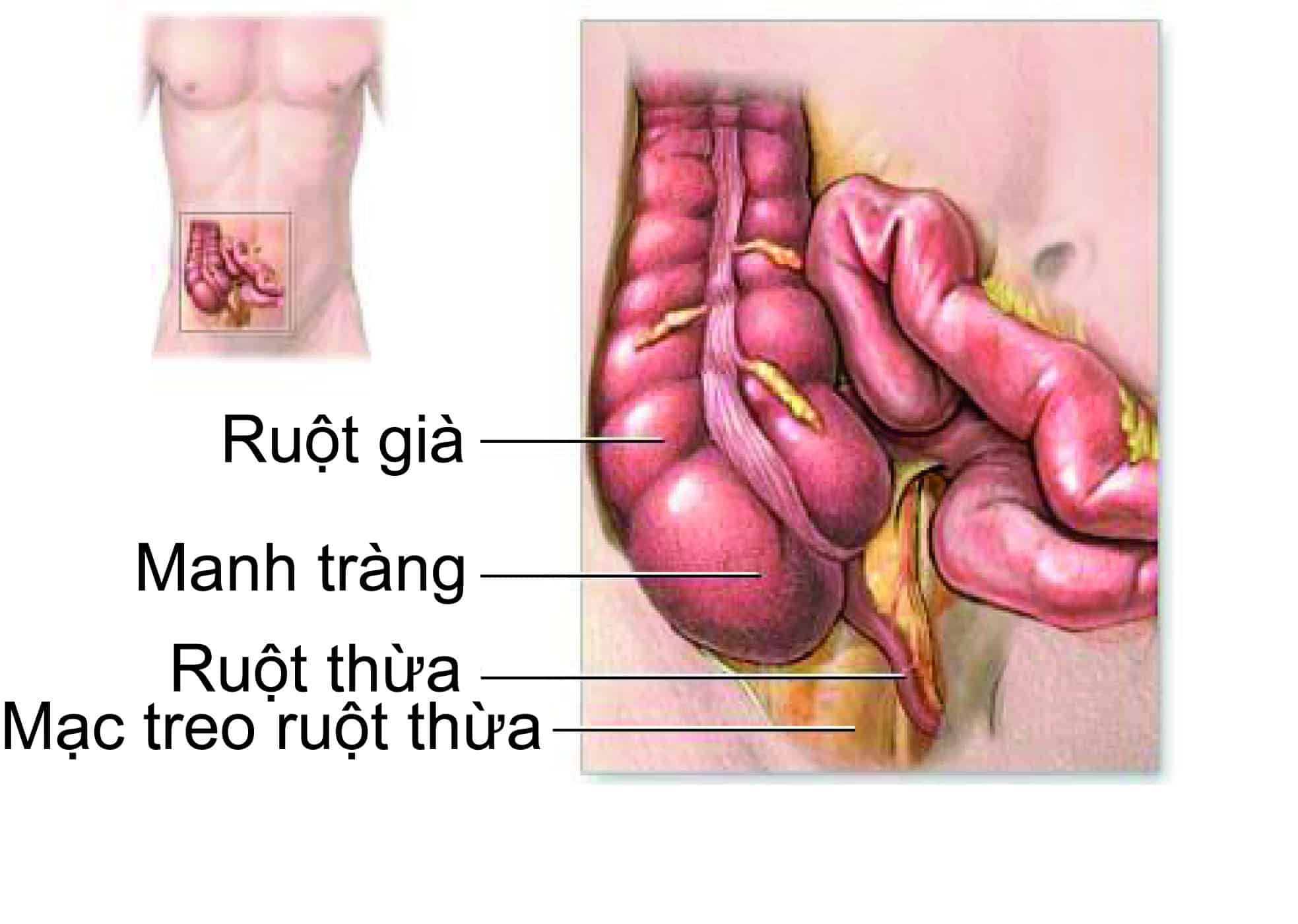 Lập Kế Hoạch Chăm Sóc Bệnh Nhân Viêm Ruột Thừa