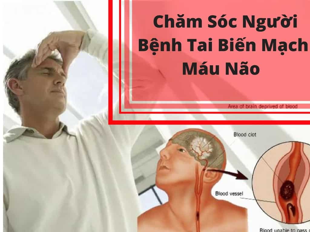 3-Kien-Thuc-Co-Ban-Giup-Cham-Soc-Nguoi-Benh-Tai-Bien-Mach-Mau-Nao-2018