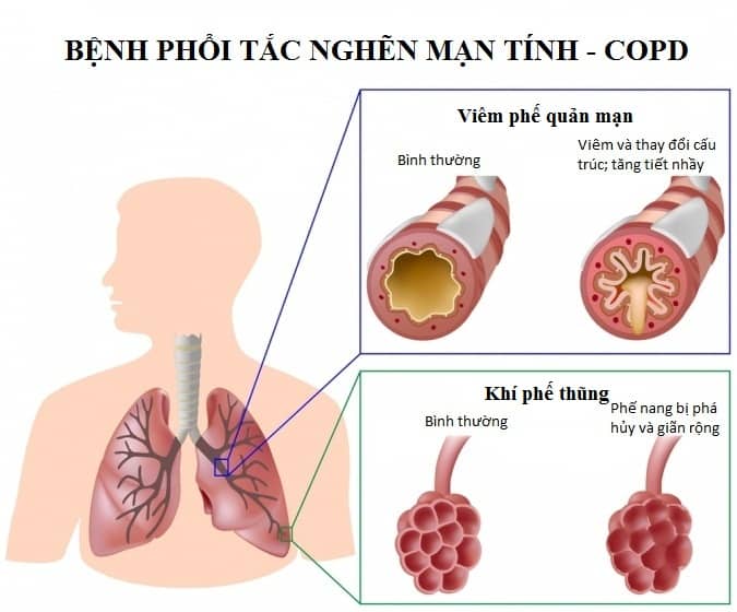 Chăm Sóc Bệnh Nhân COPD