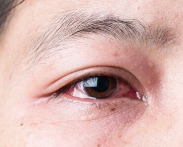 Điều trị đau mắt bằng cây thuốc nam rau má, diếp cá và lá gòn non