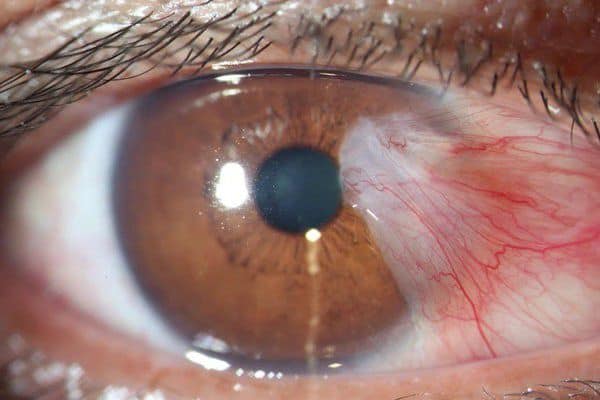 Những cây thuốc nam điều trị mắt có màng mộng