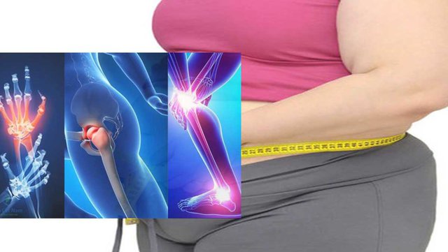 Người bị thoái hóa khớp kèm theo béo phì có nguy cơ gặp những biến chứng gì?