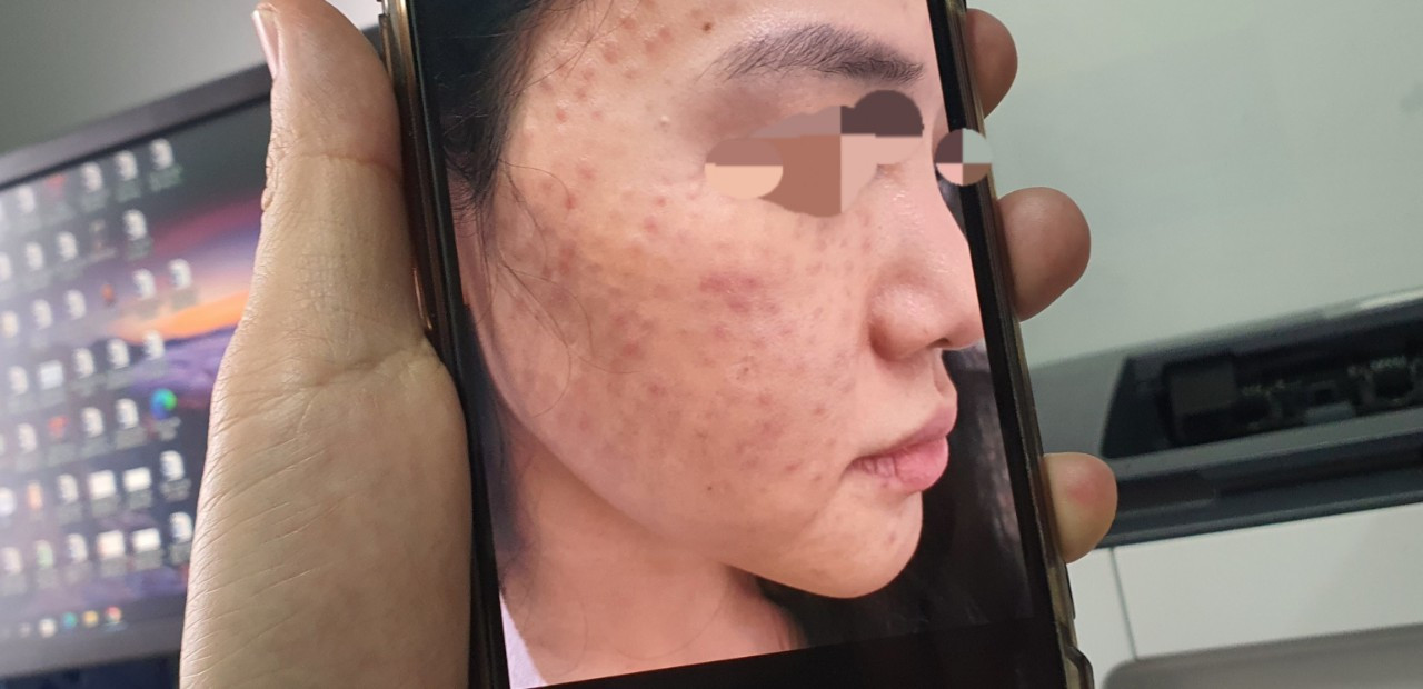 Nam thanh niên ở Hà Nội có hàng chục nốt sẩn trên má sau tiêm meso căng sáng da