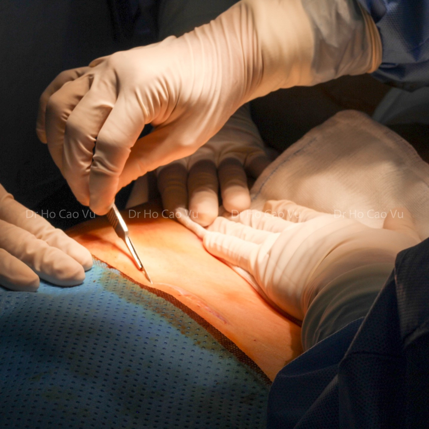 Bác sĩ chia sẻ lưu ý khi cùng lúc phẫu thuật tạo hình thành bụng, nâng ngực