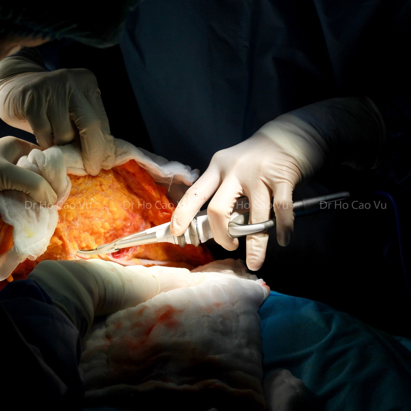 Bác sĩ chia sẻ lưu ý khi cùng lúc phẫu thuật tạo hình thành bụng, nâng ngực