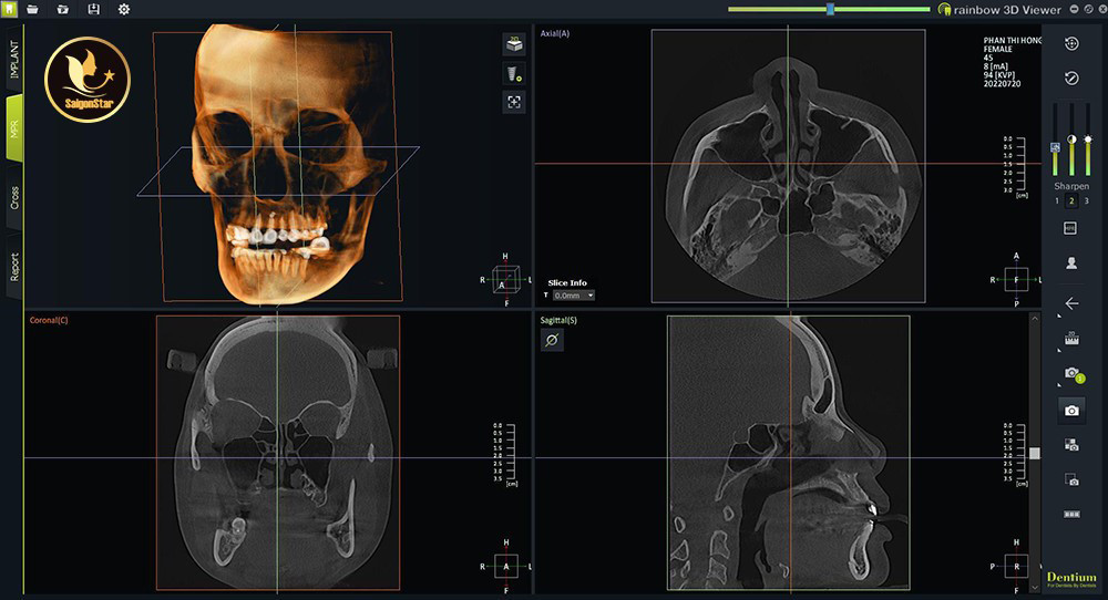 Thẩm mỹ viện Saigon Star phẫu thuật nâng mũi ứng dụng công nghệ CT 3D